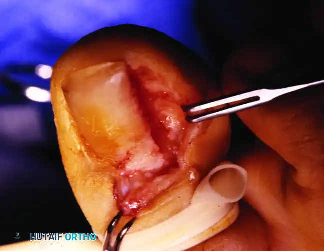 PARTIAL NAIL PLATE AND MATRIX REMOVAL Surgical Diagram