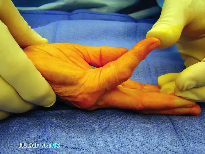 Partial Selective Fasciectomy for Dupuytren's Contracture: Surgical Masterclass