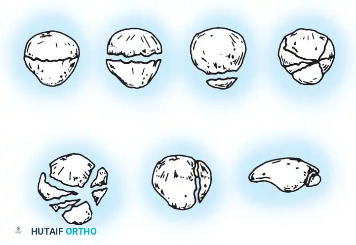 Operative Management of Patella Fractures: A Comprehensive Guide