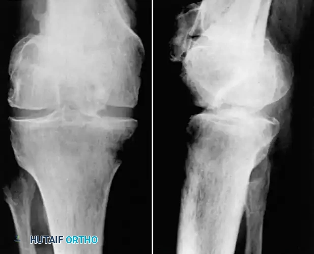 Surgical Management of Patellar and Femoral Malunions