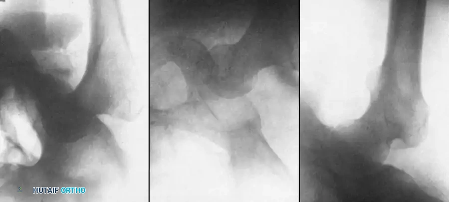 Fig. 58-3 A, Anteroposterior radiograph of left hip in 27-year-old man, illustrating posterior dislocation with myositis ossiﬁ cans, now 37 days after injury. B, Same hip on ﬁ fth day of traction. Head of femur is partially below acetabulum. C, Same hip on 17th day with reduced traction and extremity in abduction. (From Gupta RC, Shravat BP: Reduction of neglected traumatic dislocation of the hip by heavy traction, J Bone Joint Surg 59A:249, 1977.)