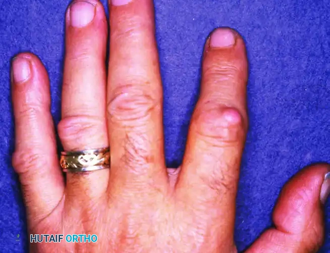 Dupuytren Contracture: Pathogenesis, Pathoanatomy, and Surgical Management