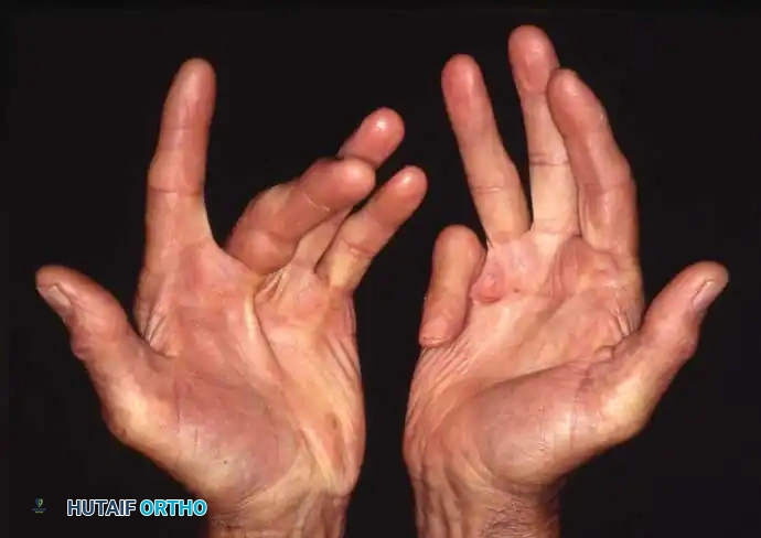 PATHOGENESIS Surgical Diagram