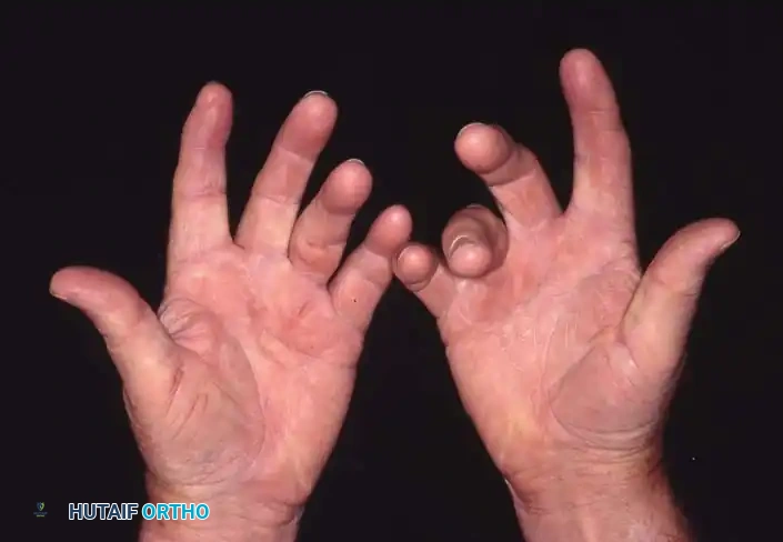 Pathogenesis and Surgical Management of Dupuytren Contracture