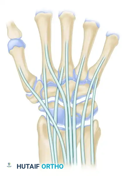 Standard radiocarpal portals