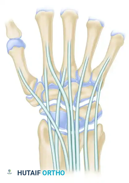 Standard radiocarpal portals alternative view