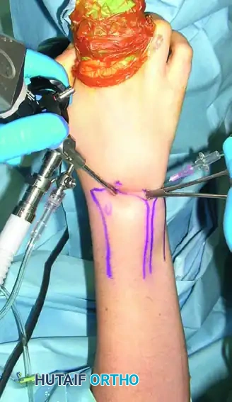 6U portal is established slightly ulnar to extensor carpi ulnaris tendon.