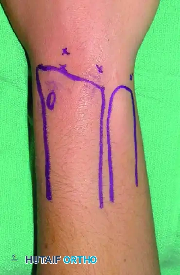 Radial and ulnar styloid are marked, and distal radius and ulna are outlined.