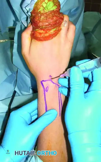 Twenty-gauge needle with bevel parallel to extensor tendons is inserted through 3-4 portal.