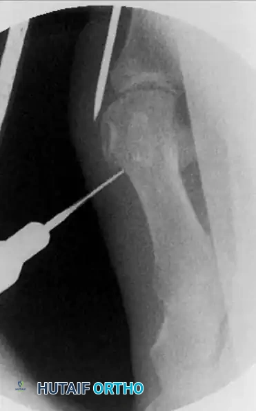 تجهيز مساحة آمنة لتعديل العظم