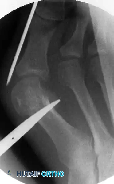 مسار السلك المعدني خارج غشاء العظم