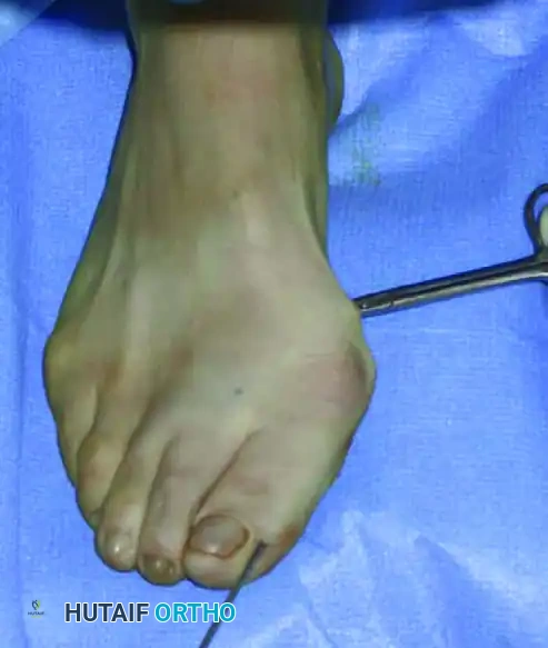 تقنية قص وتعديل العظم بدقة