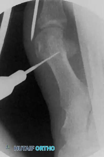 فصل الأنسجة الرخوة لحماية الأعصاب