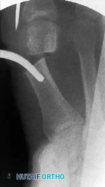 الأداة داخل القناة العظمية