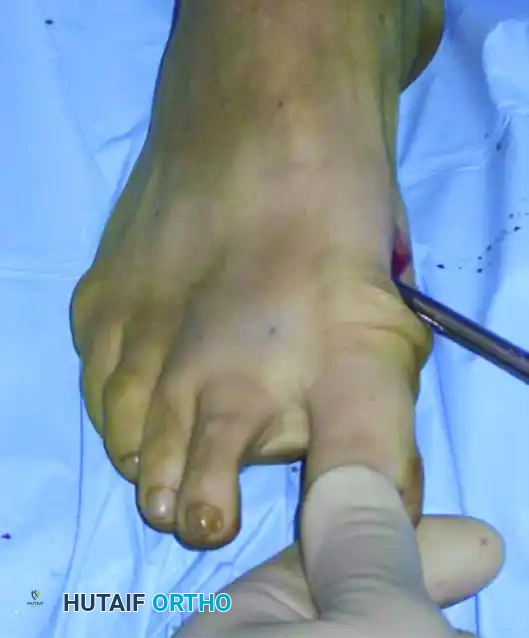 إزاحة العظم وتصحيح الانحراف