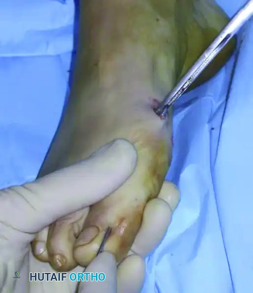 التقاء السلك بالأداة الجراحية