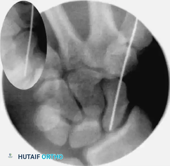 Guidewire Insertion C