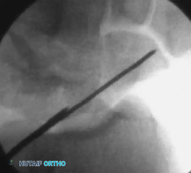 Drilling the Scaphoid