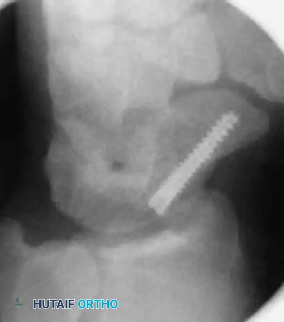 Screw Insertion C