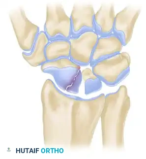 Scaphoid Fracture Diagram