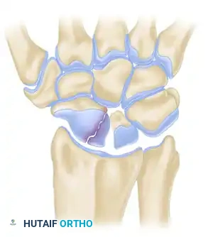 Scaphoid Fracture Comminution
