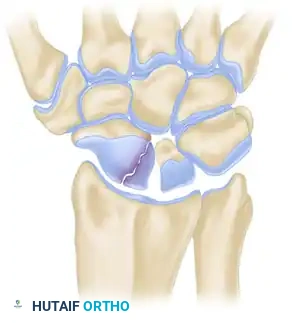 Scaphoid Fracture Displacement