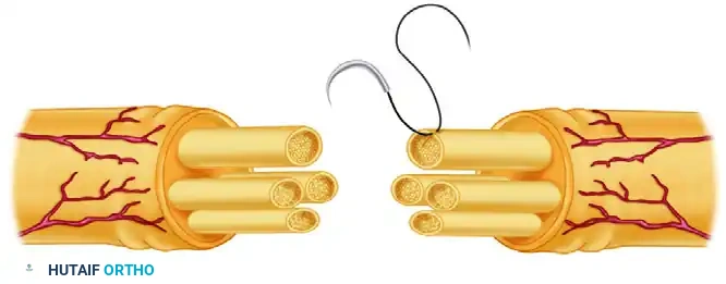 Perineurial (Fascicular) Neurorrhaphy: A Comprehensive Microsurgical Guide