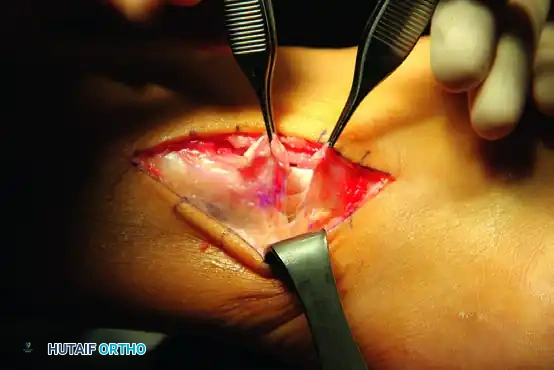 PERONEAL TENDON REPAIR-RECONSTRUCTION Surgical Diagram