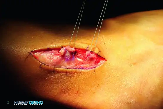 PERONEAL TENDON REPAIR-RECONSTRUCTION Surgical Diagram
