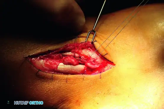 PERONEAL TENDON REPAIR-RECONSTRUCTION Surgical Diagram