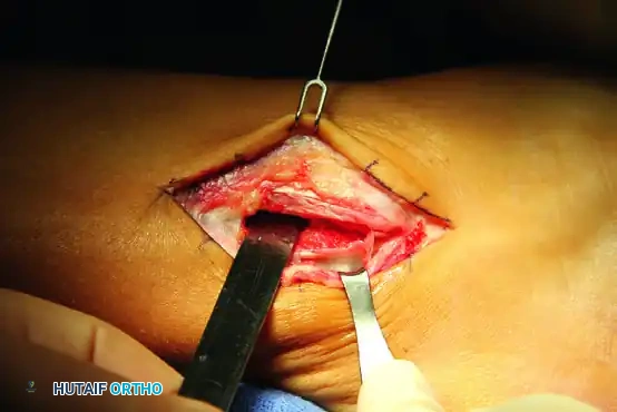 Peroneal Tendon Repair and Reconstruction: Advanced Surgical Guide