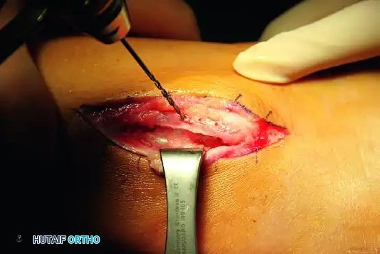 PERONEAL TENDON REPAIR-RECONSTRUCTION Surgical Diagram