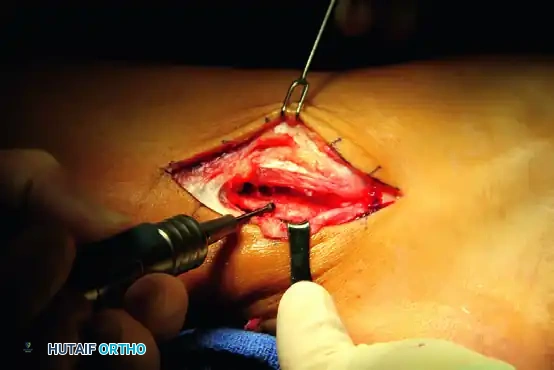 PERONEAL TENDON REPAIR-RECONSTRUCTION Surgical Diagram