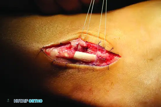 PERONEAL TENDON REPAIR-RECONSTRUCTION Surgical Diagram