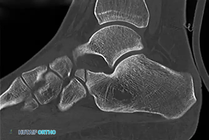 FIGURE 89-35 Avulsion fracture of talus. A, Bone scan. B, CT scan.