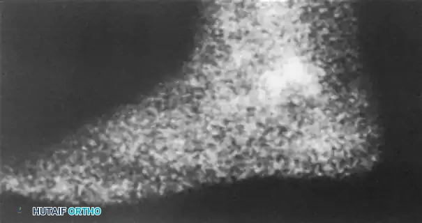 PERONEAL TENDON SUBLUXATION AND DISLOCATION Surgical Diagram