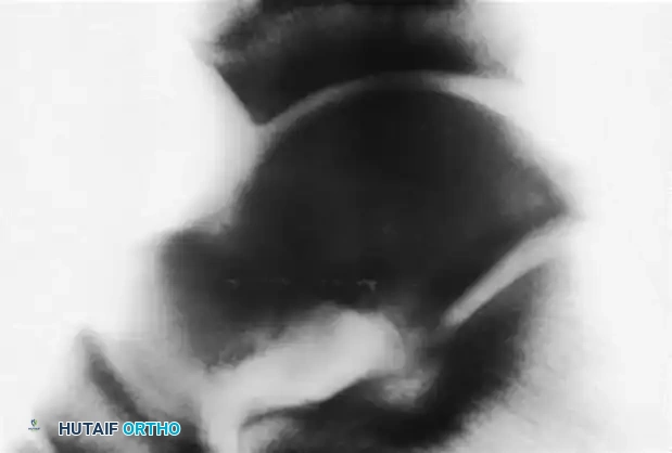 PERONEAL TENDON SUBLUXATION AND DISLOCATION Surgical Diagram