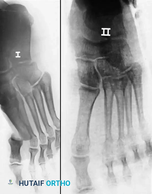 Fig. 86-53 Dorsomedial dislocation of ﬁ rst metatarsophalangeal joint. A, Dislocation could not be reduced by closed means. B, After open reduction, joint was stable.