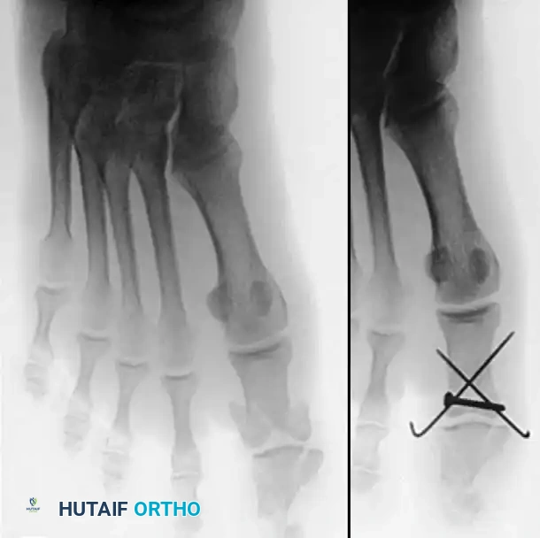 Operative Management of Phalangeal and Sesamoid Fractures