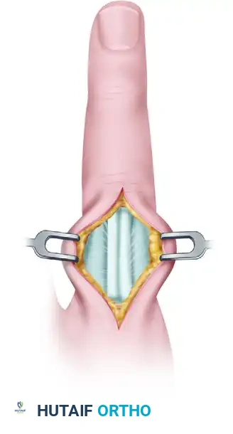 Operative Management of Proximal & Middle Phalanx Fractures