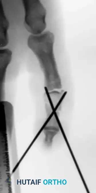 Fig. 64-48 A, Crush injury to small ﬁ nger resulting in middle phalangeal fracture. B and C, Fracture was inherently unstable and required stabilization. D and E, Pratt technique of crossed Kirschner wire ﬁ xation provided good alignment and stability.