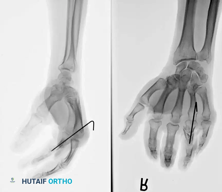Fig. 64-49 Belsky-Eaton pinning. A, Markedly unstable proximal phalangeal fracture treated by percutaneous pinning (B) across metacarpophalangeal joint. Metacarpophalangeal joint should be ﬂ exed at least 60 to 70 degrees, and proximal interphalangeal joint is not crossed.