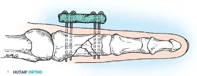 Fig. 64-51 Method for maintaining reduction of comminuted fractures of middle or proximal phalanx by using two or more percutaneous wires. These are externally stabilized by segment of polymethylmethacrylate.