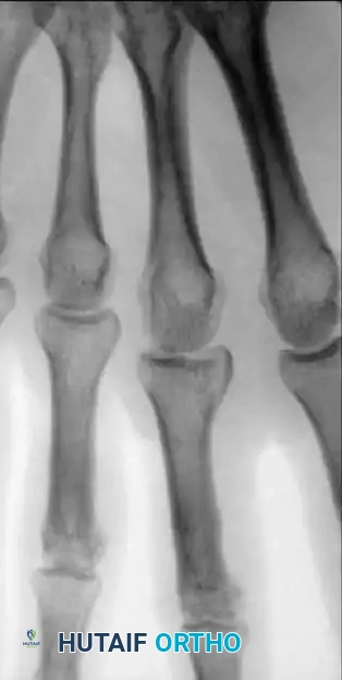 Fig. 64-50 A and B, Comminuted intraarticular fracture in middle ﬁ nger proximal phalanx base of avid tennis player treated by screw ﬁ xation.