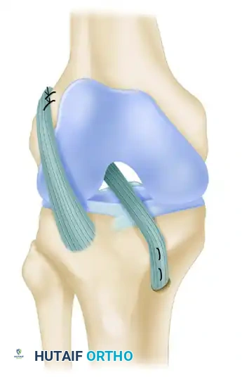 FIGURE 51-44 Technique of physeal-sparing, combined intraar­ ticular and extraarticular reconstruction of anterior cruciate liga­ ment. (Redrawn from Kocher MS, Garg S, Micheli LJ: Physeal sparing reconstruction of the anterior cruciate ligament in skeletally immature prepubescent children and adolescents, J Bone Joint Surg 87A:2371, 2005.) SEE TECHNIQUE 51-21.