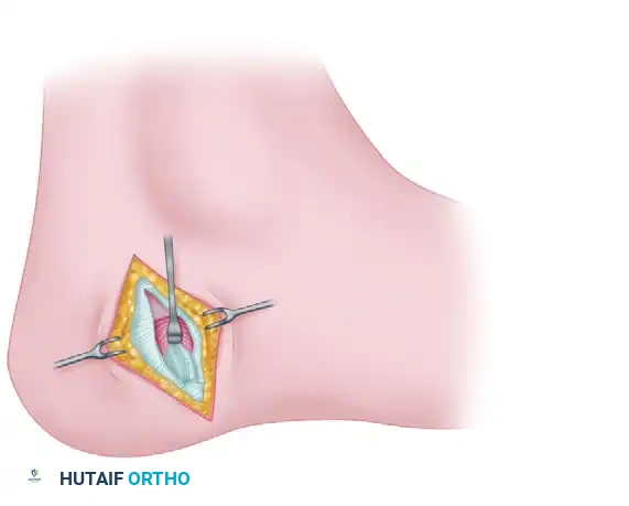 Masterclass in Plantar Fascia and Nerve Release: Open and Endoscopic Techniques