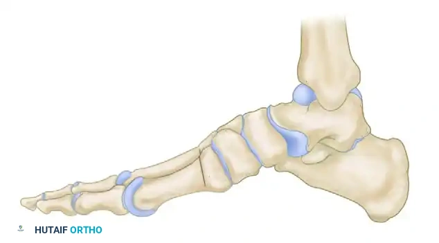 Plantar Fasciotomy and Closing Wedge Metatarsal Osteotomy: The Gould Technique