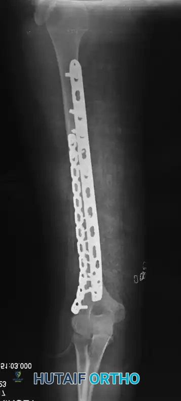 FIGURE 57-35 Anterior plating of humeral shaft fracture with limited-contact dynamic compression plate in neutralization mode with lag screw.