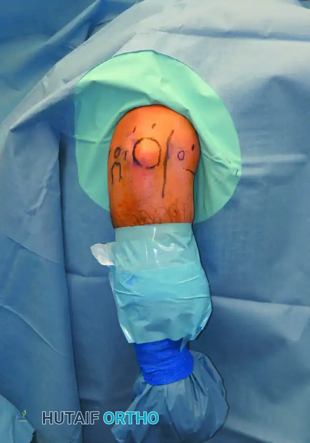 PORTAL PLACEMENT Surgical Diagram