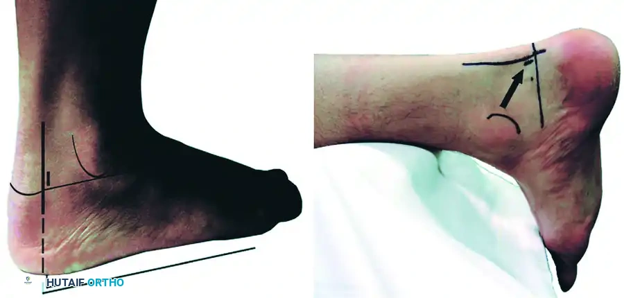 POSTERIOR DÉBRIDEMENT FOR ANKLE IMPINGEMENT Surgical Diagram